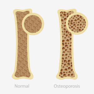 A comparison of healthy bone and bone with osteoporosis